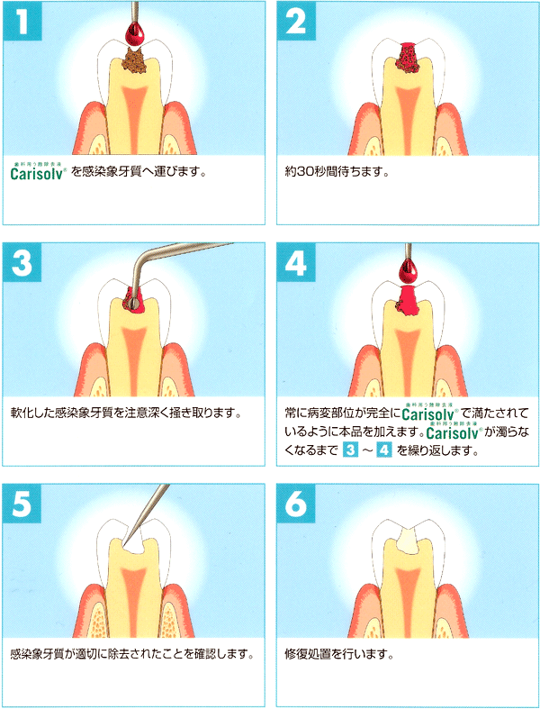 �J���\���u�̑�����@����юg�p���@