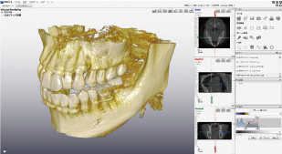 歯科用CTデジタル処理