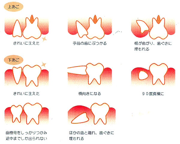 親知らず 横向き