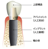 インプラントの構造